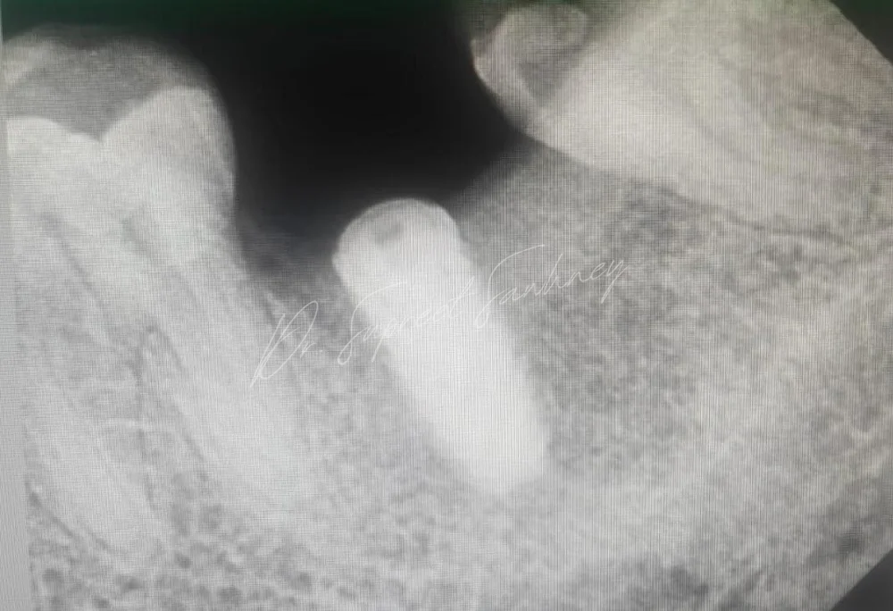 Periapical radiograph showing a dental implant at a posterior mandibular site